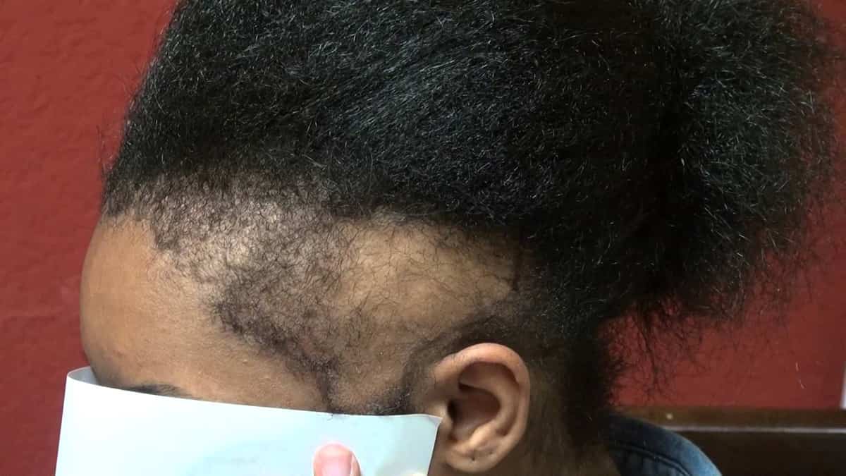 African American Toddler Hair Loss