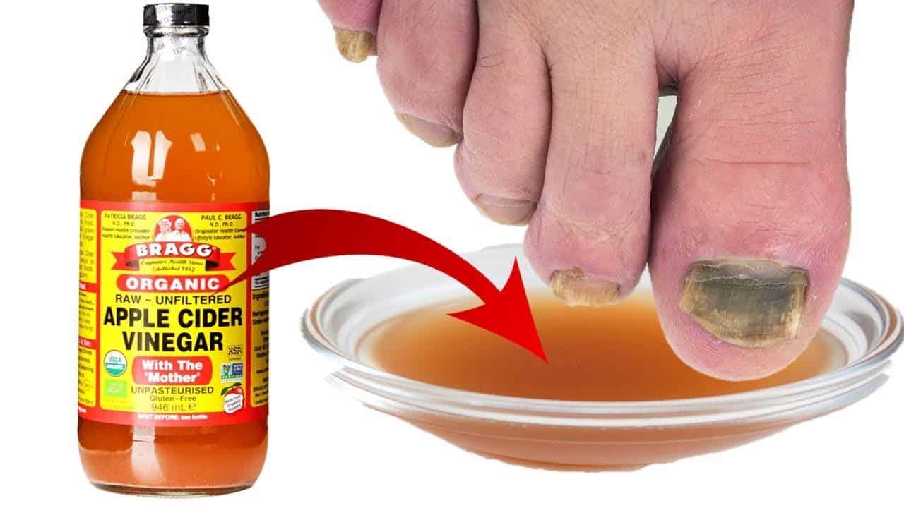 Use apple cider vinegar to Treat Ingrown Nails